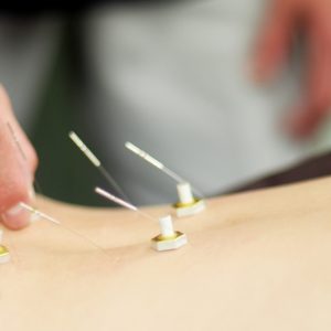 Woman receiving acupuncture and moxibustion in Japan