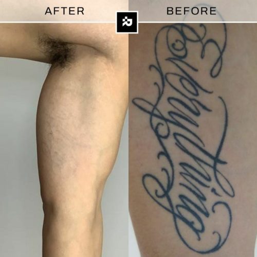 Removery Before & After 2