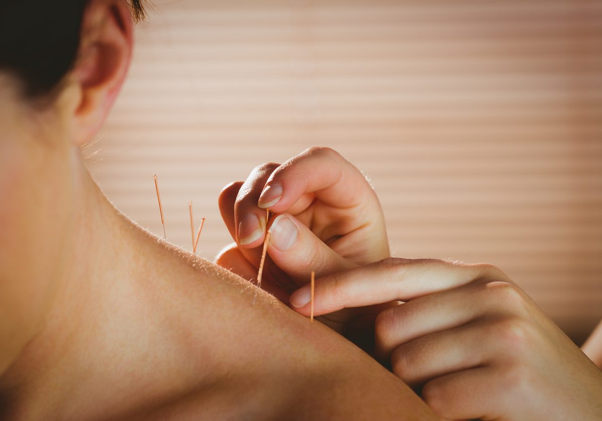 Young woman getting acupuncture treatment