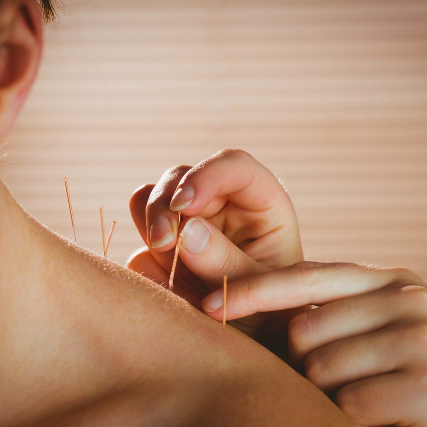 Young woman getting acupuncture treatment